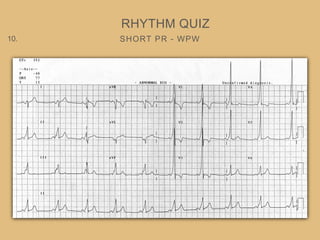 SHORT PR - WPW
RHYTHM QUIZ
10.
 