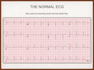 THE NORMAL ECG
Get used to knowing what normal looks like.
 