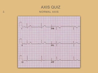 NORMAL AXIS
AXIS QUIZ
2.
 