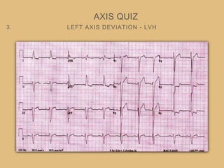LEFT AXIS DEVIATION - LVH
AXIS QUIZ
3.
 