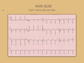LEFT AXIS DEVIATION
AXIS QUIZ
4.
 
