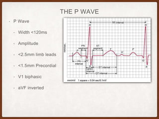 THE P WAVE
• P Wave
• Width <120ms
• Amplitude
• <2.5mm limb leads
• <1.5mm Precordial
• V1 biphasic
• aVF inverted
 