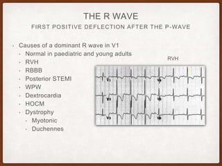 FIRST POSITIVE DEFLECTION AFTER THE P-WAVE
THE R WAVE
• Causes of a dominant R wave in V1
• Normal in paediatric and young adults
• RVH
• RBBB
• Posterior STEMI
• WPW
• Dextrocardia
• HOCM
• Dystrophy
• Myotonic
• Duchennes
RVH
 