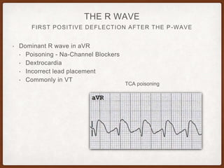 FIRST POSITIVE DEFLECTION AFTER THE P-WAVE
THE R WAVE
• Dominant R wave in aVR
• Poisoning - Na-Channel Blockers
• Dextrocardia
• Incorrect lead placement
• Commonly in VT
TCA poisoning
 
