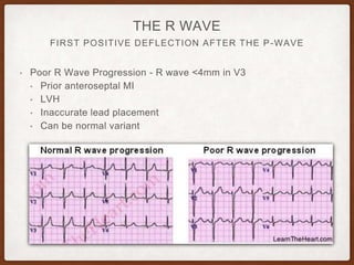 FIRST POSITIVE DEFLECTION AFTER THE P-WAVE
THE R WAVE
• Poor R Wave Progression - R wave <4mm in V3
• Prior anteroseptal MI
• LVH
• Inaccurate lead placement
• Can be normal variant
 