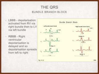 THE QRS
• LBBB - depolarisation
activated from RV via
right bundle then to LV
via left bundle
• RBBB - Right
ventricular
depolarisation is
delayed and so
depolarisation spreads
from left to right
BUNDLE BRANCH BLOCK
 