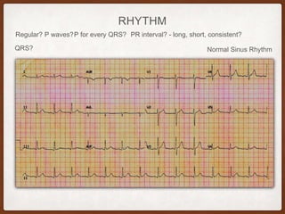 RHYTHM
Regular? P waves? PR interval? - long, short, consistent?P for every QRS?
QRS? Normal Sinus Rhythm
 