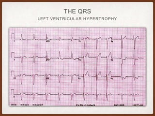 LEFT VENTRICULAR HYPERTROPHY
THE QRS
 