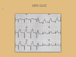 QRS QUIZ
1.
 