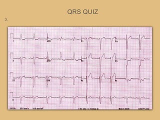 QRS QUIZ
3.
 