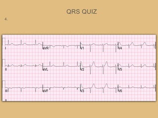 QRS QUIZ
4.
 