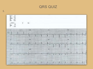 QRS QUIZ
5.
 