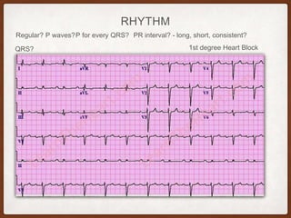RHYTHM
Regular? P waves? PR interval? - long, short, consistent?P for every QRS?
QRS? 1st degree Heart Block
 