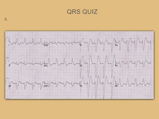 QRS QUIZ
6.
 