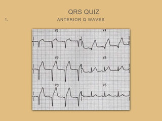 ANTERIOR Q WAVES
QRS QUIZ
1.
 