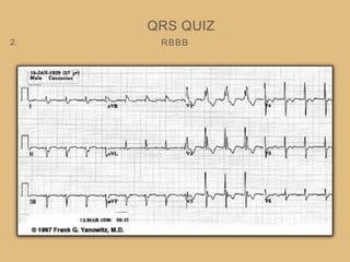 RBBB
QRS QUIZ
2.
 
