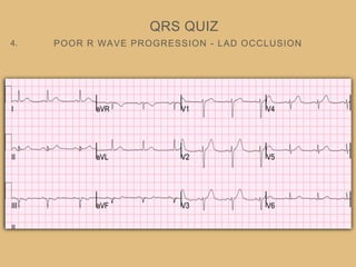 POOR R WAVE PROGRESSION - LAD OCCLUSION
QRS QUIZ
4.
 