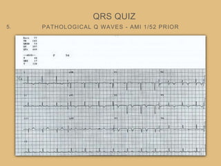 PATHOLOGICAL Q WAVES - AMI 1/52 PRIOR
QRS QUIZ
5.
 