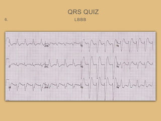 LBBB
QRS QUIZ
6.
 