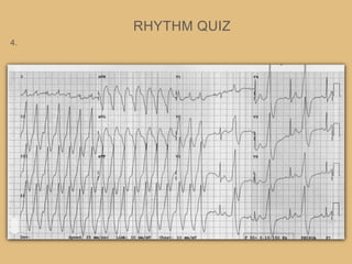 life in the fast lane ecg quiz