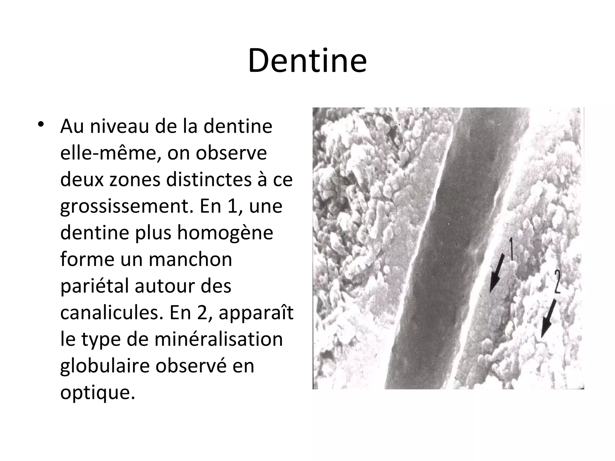 Dentine
• Au niveau de la dentine
elle-même, on observe
deux zones distinctes à ce
grossissement. En 1, une
dentine plus homogène
forme un manchon
pariétal autour des
canalicules. En 2, apparaît
le type de minéralisation
globulaire observé en
optique.
 