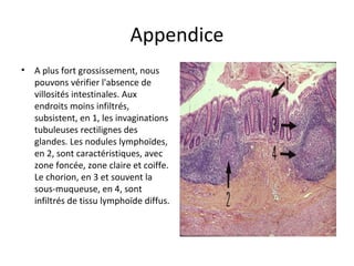Appendice
• A plus fort grossissement, nous 
pouvons vérifier l'absence de 
villosités intestinales. Aux 
endroits moins infiltrés, 
subsistent, en 1, les invaginations 
tubuleuses rectilignes des 
glandes. Les nodules lymphoïdes, 
en 2, sont caractéristiques, avec 
zone foncée, zone claire et coiffe. 
Le chorion, en 3 et souvent la 
sous-muqueuse, en 4, sont 
infiltrés de tissu lymphoïde diffus. 
 