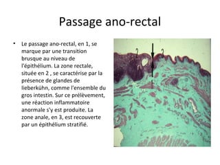 Passage ano-rectal
• Le passage ano-rectal, en 1, se 
marque par une transition 
brusque au niveau de 
l'épithélium. La zone rectale, 
située en 2 , se caractérise par la 
présence de glandes de 
lieberkühn, comme l'ensemble du 
gros intestin. Sur ce prélèvement, 
une réaction inflammatoire 
anormale s'y est produite. La 
zone anale, en 3, est recouverte 
par un épithélium stratifié. 
 