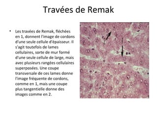 Travées de Remak
• Les travées de Remak, fléchées 
en 1, donnent l'image de cordons 
d'une seule cellule d'épaisseur. Il 
s'agit toutefois de lames 
cellulaires, sorte de mur formé 
d'une seule cellule de large, mais 
avec plusieurs rangées cellulaires 
superposées. Une coupe 
transversale de ces lames donne 
l'image fréquente de cordons, 
comme en 1, mais une coupe 
plus tangentielle donne des 
images comme en 2. 
 