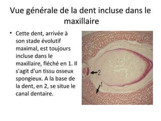 Vue générale de la dent incluse dans le
maxillaire
• Cette dent, arrivée à
son stade évolutif
maximal, est toujours
incluse dans le
maxillaire, fléché en 1. Il
s'agit d'un tissu osseux
spongieux. A la base de
la dent, en 2, se situe le
canal dentaire.
 