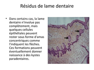 Résidus de lame dentaire
• Dans certains cas, la lame
dentaire n'involue pas
complètement, mais
quelques cellules
épithéliales peuvent
rester sous forme d'amas
concentriques comme
l'indiquent les flèches.
Ces formations peuvent
éventuellement donner
naissance à des kystes
paradentaires.
 