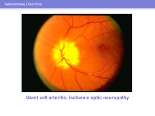 Ocular Manifestations of Systemic Disease | PDF