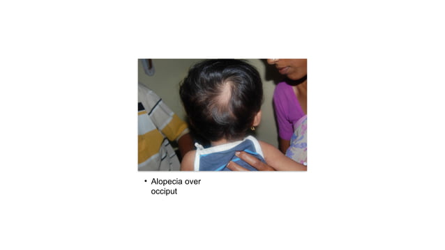 Systemic-onset juvenile idiopathic arthritis in children.pptx