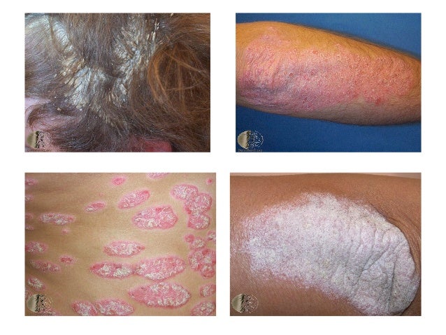 Systemic treatment for psoriasis Systemic treatment for psoriasis