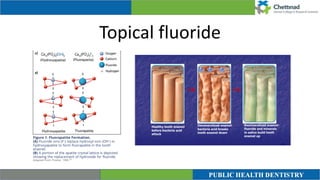 Topical fluoride
 