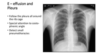 Systemic approach for reading Chest X-rays.pdf