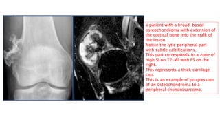 CHONDROSARCOMA
Malignant bone tumor that produces cartilage.
 usually central and metaphyseal
Typical presentation: large...