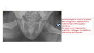 Systemic approach to bone tumor radiology