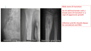 Age is one of the most important
clues for correct diagnosis of
bone tumors
 