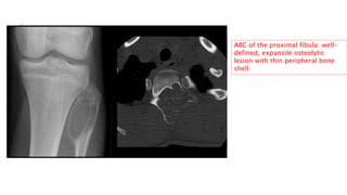 On MR imaging bone infarcts are
characterized by irregulair
serpentiginous margins with low
signal intensity on both T1 an...