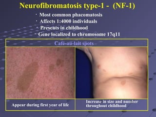 Nf1 Features Systemic Diseases and the Eye | PPT