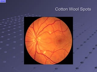 Cotton Eye Problem Systemic Diseases and the Eye | PPT