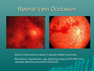 Retinal Vein OcclusionRetinal Vein Occlusion
Second most common cause of vascular-related visual loss.
Risk factors: hypertension, age, blood dyscrasias (OCP,HRT) and
vasculitis (Behcets,sarcoidosis,AIDS,SLE)
 