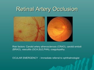 Retinal Artery OcclusionRetinal Artery Occlusion
Risk factors: Carotid artery atherosclerosis (CRAO), carotid emboli
(BRAO), vasculitis (GCA,SLE,PAN), coagulopathy.
OCULAR EMERGENCY - Immediate referral to ophthalmologist
 