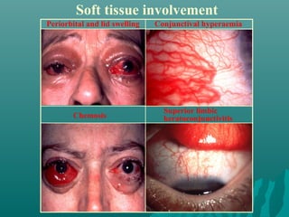 Soft tissue involvement
Periorbital and lid swelling
Chemosis
Conjunctival hyperaemia
Superior limbic
keratoconjunctivitis
 