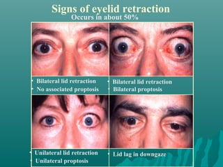 Signs of eyelid retraction
Occurs in about 50%
• Bilateral lid retraction
• No associated proptosis
• Bilateral lid retraction
• Bilateral proptosis
• Lid lag in downgaze• Unilateral lid retraction
• Unilateral proptosis
 