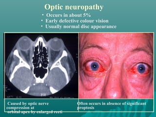 Optic neuropathy
• Occurs in about 5%
• Early defective colour vision
• Usually normal disc appearance
Caused by optic nerve
compression at
orbital apex by enlarged recti
Often occurs in absence of significant
proptosis
 