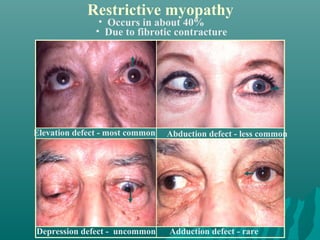 • Occurs in about 40%
• Due to fibrotic contracture
Restrictive myopathy
Elevation defect - most common Abduction defect - less common
Depression defect - uncommon Adduction defect - rare
 