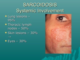 SARCOIDOSISSARCOIDOSIS
Systemic InvolvementSystemic Involvement
 Lung lesions –Lung lesions –
95%95%
 Thoracic lymphThoracic lymph
nodes – 50%nodes – 50%
 Skin lesions – 30%Skin lesions – 30%
→→
 Eyes – 30%Eyes – 30%
 
