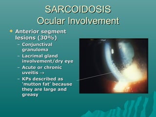 SARCOIDOSISSARCOIDOSIS
Ocular InvolvementOcular Involvement
 Anterior segmentAnterior segment
lesions (30%)lesions (30%)
– ConjunctivalConjunctival
granulomagranuloma
– Lacrimal glandLacrimal gland
involvement/dry eyeinvolvement/dry eye
– Acute or chronicAcute or chronic
uveitisuveitis →→
– KPs described asKPs described as
‘mutton fat’ because‘mutton fat’ because
they are large andthey are large and
greasygreasy
 