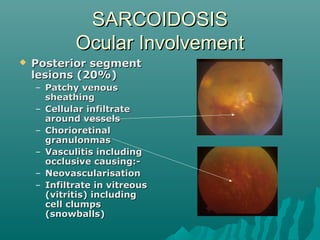 SARCOIDOSISSARCOIDOSIS
Ocular InvolvementOcular Involvement
 Posterior segmentPosterior segment
lesions (20%)lesions (20%)
– Patchy venousPatchy venous
sheathingsheathing
– Cellular infiltrateCellular infiltrate
around vesselsaround vessels
– ChorioretinalChorioretinal
granulonmasgranulonmas
– Vasculitis includingVasculitis including
occlusive causing:-occlusive causing:-
– NeovascularisationNeovascularisation
– Infiltrate in vitreousInfiltrate in vitreous
(vitritis) including(vitritis) including
cell clumpscell clumps
(snowballs)(snowballs)
 